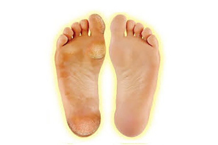 Ayaklarınıza Sağlıklı Bakmanın 10 Yolu 10 nasırlı ve nasırsız ayak