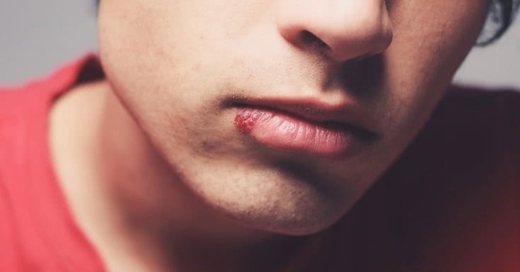 Evde Uygulanan 10 Yanlış Doğal Tedavi 3 sivilce