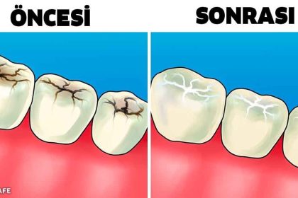 Diş Doktorlarına Sorulmuş En Önemli Soruların Cevapları 18 diş doktorlarına sorulmuş en önemli soruların cevapları