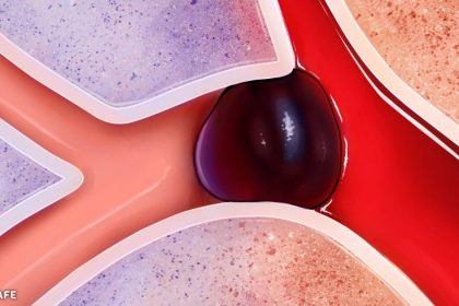 felç, baş ağrısı ve halsizlik nasıl geçer