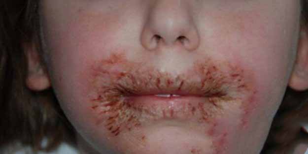 8 Yaşındaki Kızının Yüzünde Yaralar Çıkıyordu Anne Sebebini Öğrenince Çok Şaşırdı 4 yara