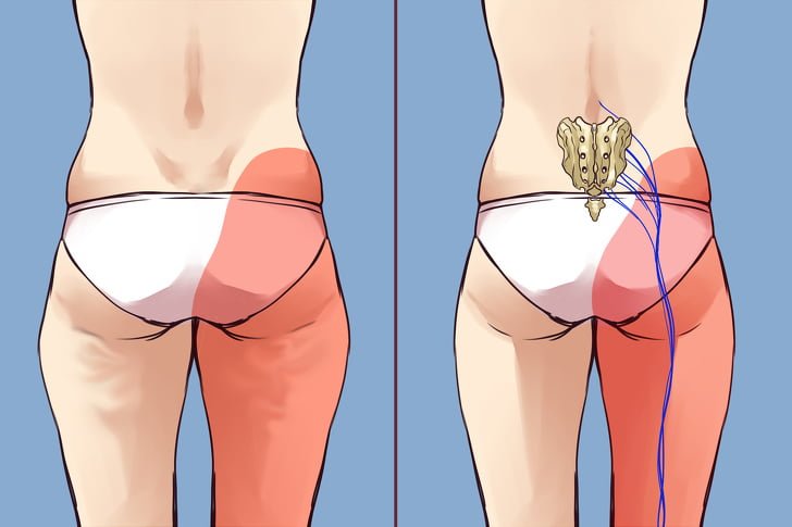 Lenf Kanseri Olmamak İçin 7 Egzersiz 7 bel kalça