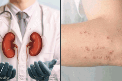 Böbreklerinizin Hasta Olduğunu Gösteren İşaretler 14 böbreklerin tehlikede olduğunun belirtileri