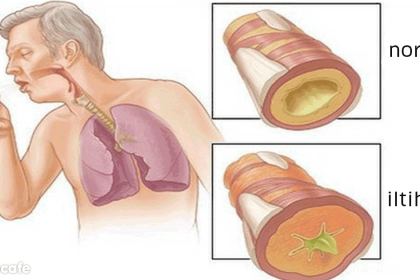 ciğerleri temizleyen bitkiler