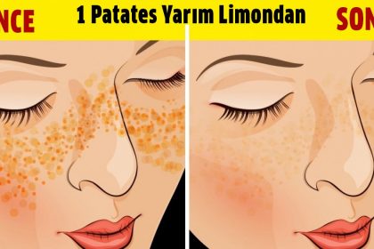 Siyah Noktalardan, Aknelerden ve Yüzünüzdeki İzlerden 5 günde Kurtulun 24 patates yarim limon