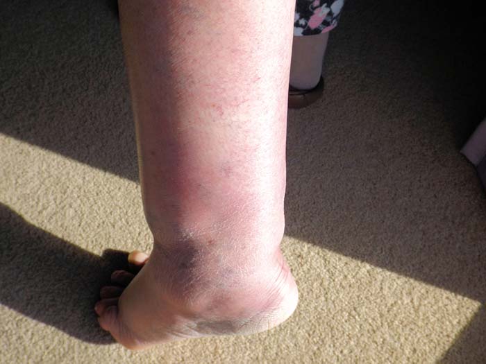 Vücudunuzdaki Birikmiş Ödemi Atmanın Doğal Çaresi 2 ayaktaki odem