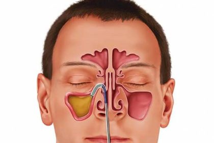 Sinüs Enfeksiyonunu Evde Tedavi Edin 4 sinuzit evde