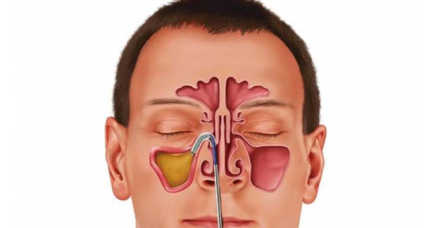 Sinüs Enfeksiyonunu Evde Tedavi Edin 22 sinuzit evde