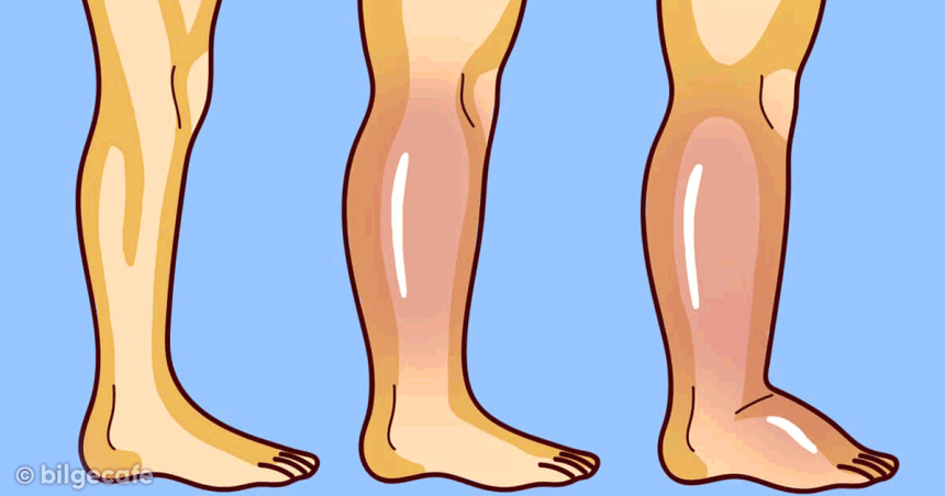 Vücudunuzdaki Birikmiş Ödemi Atmanın Doğal Çaresi 6 siskin ayaklarin dogal caresi