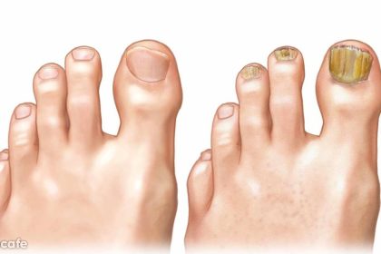 Tırnak Mantarından Kurtulmak Bu Kadar Basitmiş 8 tırnak mantarı