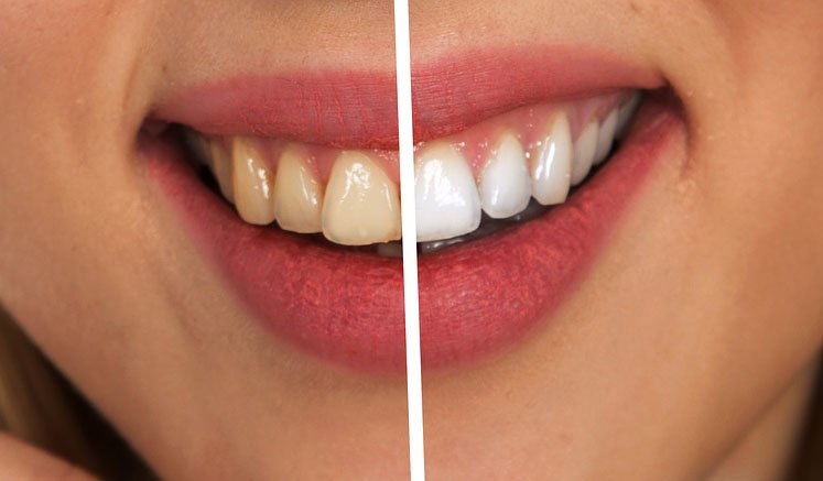 Dişçiye Gitmeden Evde Dişlerinizi Eski Sağlığına Kavuşturun 3 diş öncesi sonrası