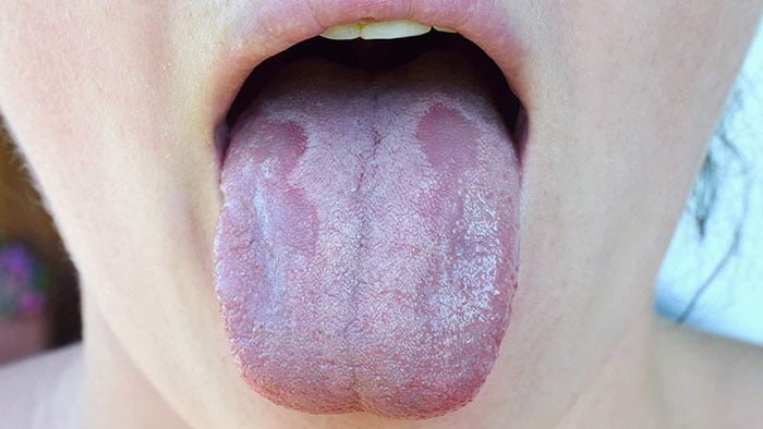 Vücudumuz B12'ye İhtiyacı Olduğunu Bu Şekilde Gösteriyor 5 ağız içi iltihaplanma