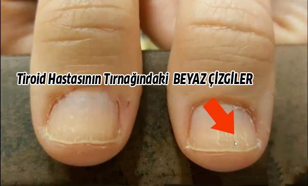 Tiroid Belirtileri, Tiroidi Tırnağınıza Bakarak Anlayın 3 beyaz cizgiler
