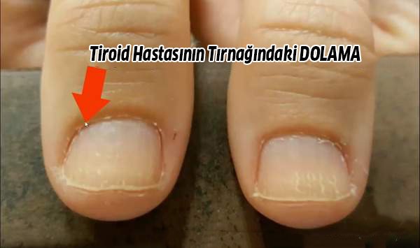Tiroid Belirtileri, Tiroidi Tırnağınıza Bakarak Anlayın 2 dolama tiroid