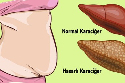 Karaciğerinizin Toksinlerle Dolu Olduğunun 6 Belirtisi! 20 karacigerinizin toksinlerle dolu oldugunun 6 belirtisi