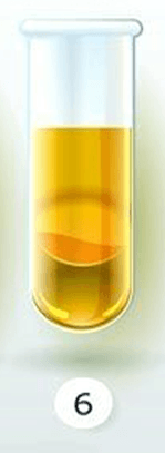 İdrarınızın Rengi Sağlığınız Hakkında Ne Diyor? 7 koyu şerbet