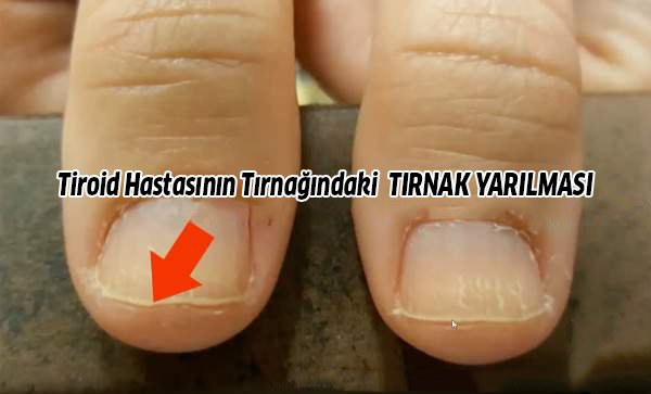 Tiroid Belirtileri, Tiroidi Tırnağınıza Bakarak Anlayın 4 tirnak yarilmasi