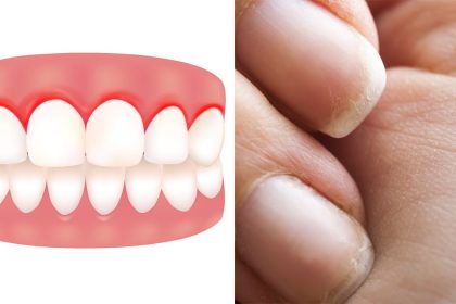 Vücudunuzun C Vitamini Bitmiş Olduğunun 10 Erken Belirtisi 14 vitamin eksikligi