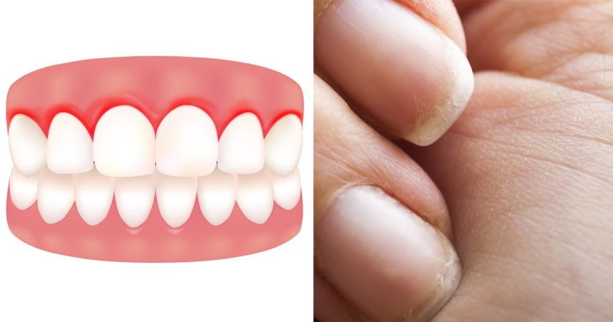 Vücudunuzun C Vitamini Bitmiş Olduğunun 10 Erken Belirtisi 30 vitamin eksikligi