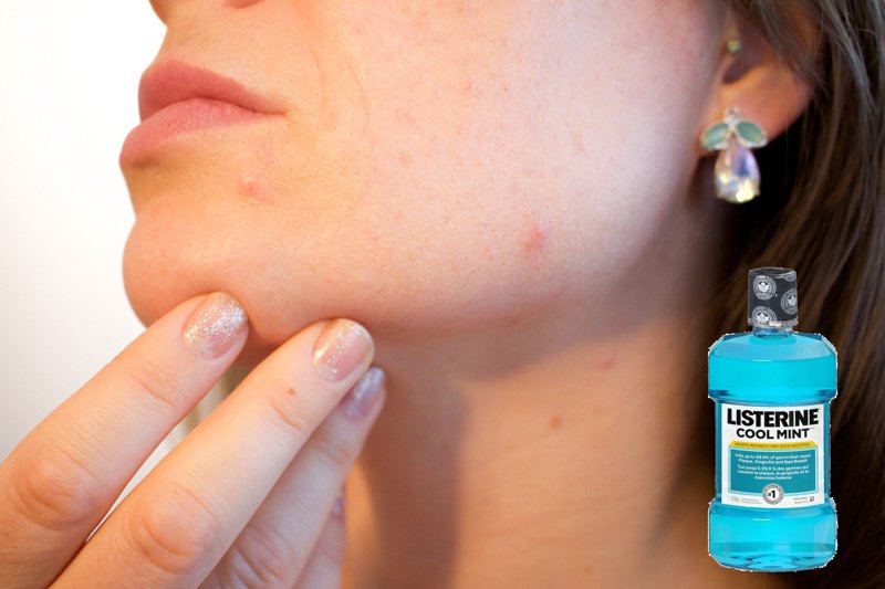 Ağız Gargarasıyla Neler Yapılabilir? 5 agiz gargarasi akne2