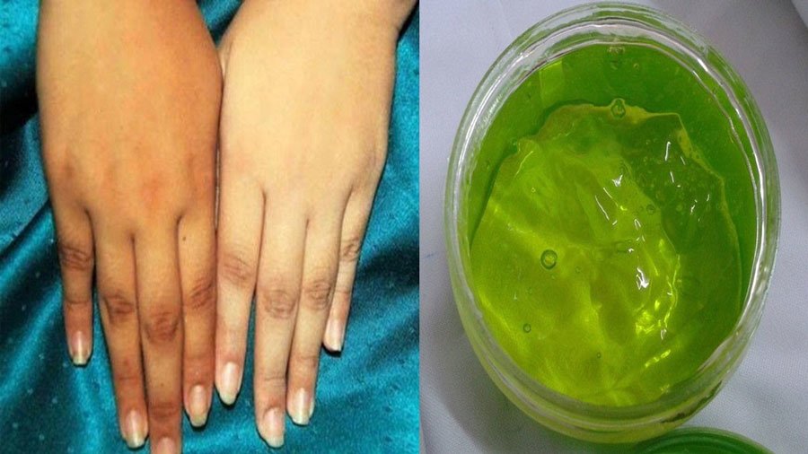 Vücuttaki Kararmalardan Nasıl Kurtulursunuz? 5 aloe vera