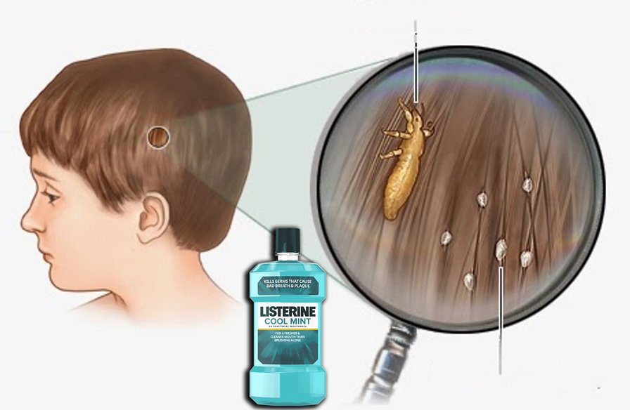 Ağız Gargarasıyla Neler Yapılabilir? 4 bitlenme2