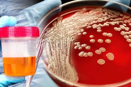 Böbreklerinizde Sorun Olduğunu Gösteren 8 Önemli Belirti 18 böbreklerde sorun olduğunun belirtileri