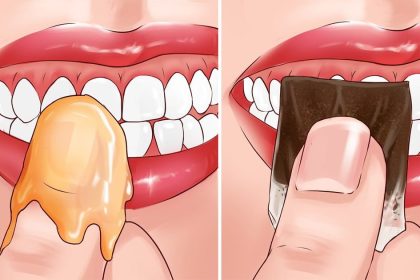 Kanayan ve Ağrıyan Dişlere Ne İyi Gelir? 4 dis agrisi kanama