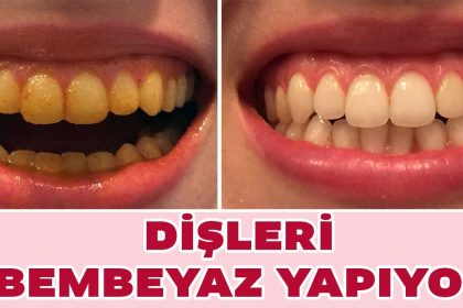 Hiç Bir Şey Komşumun Verdiği Tarif Kadar Dişlerimi Beyazlatmadı 22 disleri beyazlastiriyor