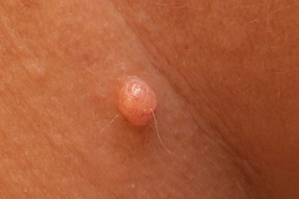 Et Benlerinden Evde Kurtulmanın En Basit ve Kesin Yolu 24 et benlerinden evde dogal yontemle kurtulmak