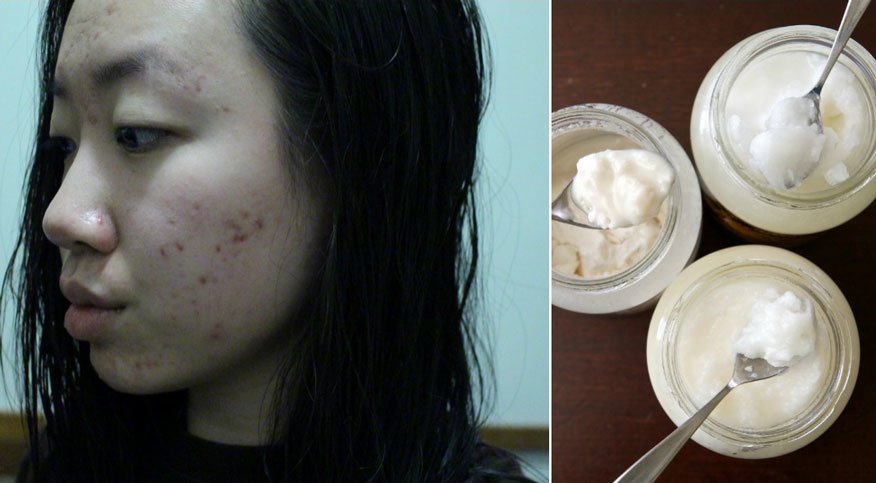 Yüzünüzdeki veya Vücuttaki Kırmızı Lekelerin Sebebi Nedir? Ne İyi Gelir? 6 hindistan cevizi yagi2