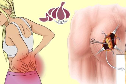 iltihap ve siyatik sinir