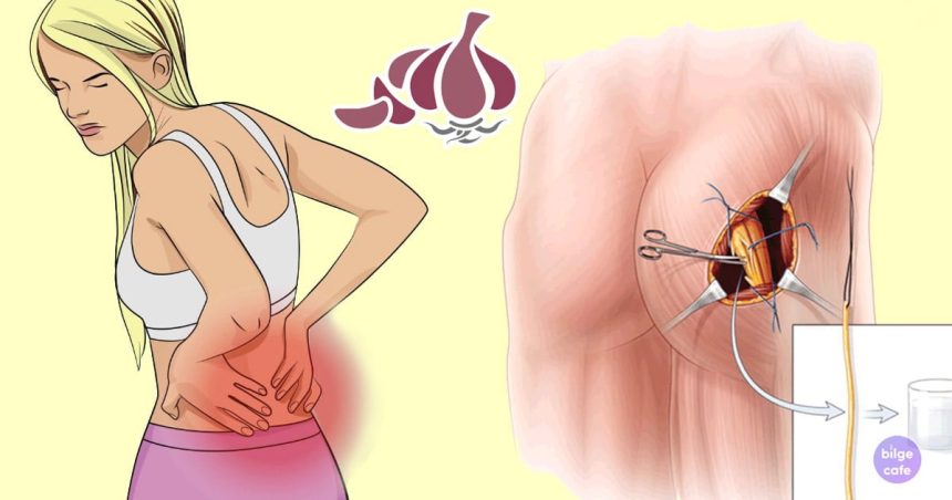 iltihap ve siyatik sinir