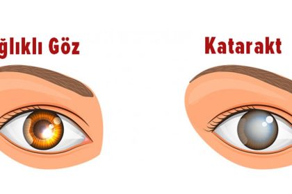 Yaşa Bağlı Katarakt'ın İlk Belirtileri 20 katrakt belirtileri
