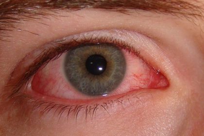 Kızaran Gözlerinizin ve Boğaz Ağrınızın Nedeni Çamaşır Makineniz Olabilir 12 kizaran gozler2