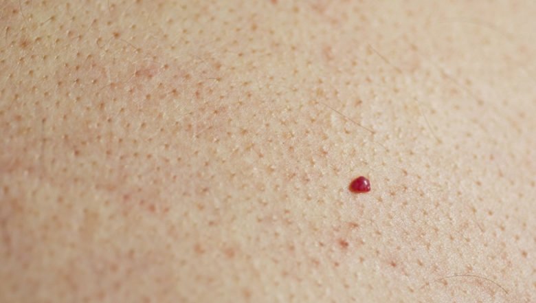 Yüzünüzdeki veya Vücuttaki Kırmızı Lekelerin Sebebi Nedir? Ne İyi Gelir? 3 leke3 e1568803874101