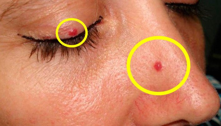 Yüzünüzdeki veya Vücuttaki Kırmızı Lekelerin Sebebi Nedir? Ne İyi Gelir? 2 lekeler2