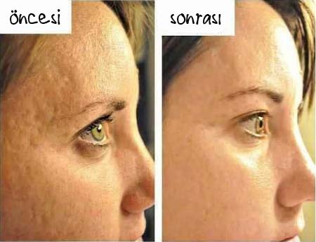 limon cilt delikleri