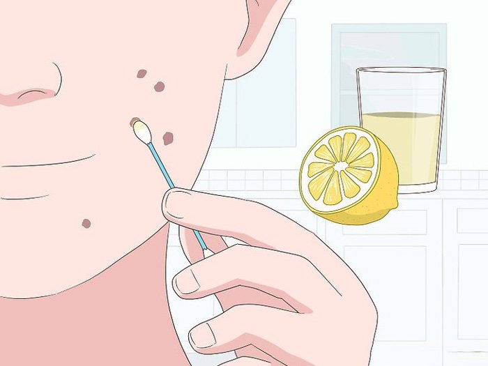 Yüzünüzdeki veya Vücuttaki Kırmızı Lekelerin Sebebi Nedir? Ne İyi Gelir? 8 limon suyu