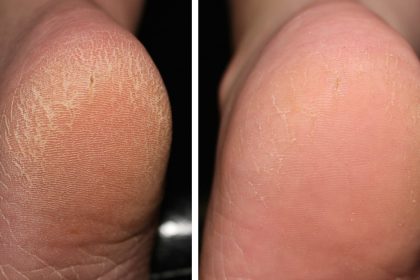 Ayaklarınız Yeniden Doğmuş Gibi Olacak 24 once sonra ayak