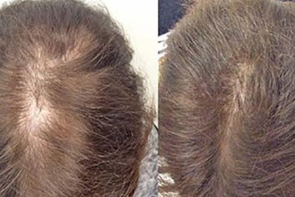 Saç Dökülmesini Durdurmak ve Saçınızı Gürleştirmek İçin Doğal Tarifler 12 saç dökülmesine doğal tarifler