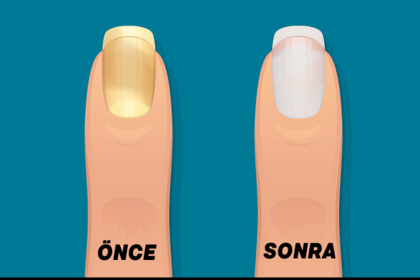 Sararan Tırnaklara Ne İyi Gelir? 24 sararmis tirnaklar