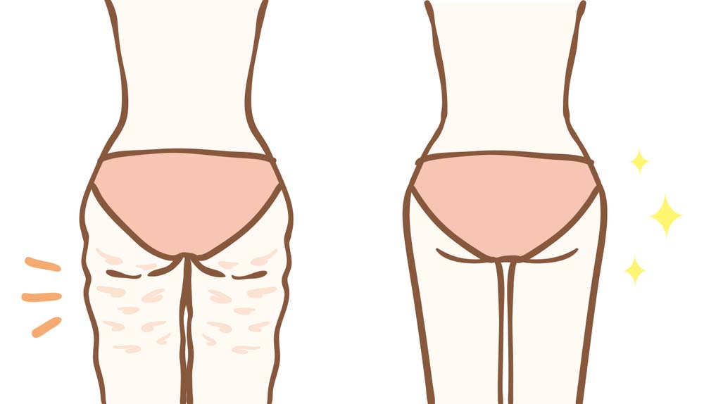 Her Kadın Hayatını Kolaylaştıracak Bu Basit Ve Şaşırtıcı Sırları Bilmeli 4 selulit