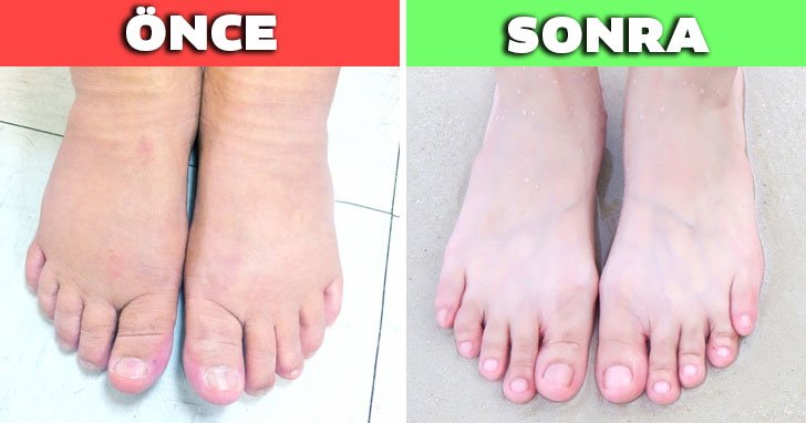 Ayak Banyosuyla Vücuttaki Pislikler Nasıl Atılıp Rahatlanır? 2 sismis ayaklar