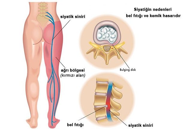siyatik e1579623587703