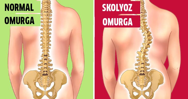 Anne ve Babaların Farkında Olmadan Çocuklarına Zarar Verdiği 11 Konu 2 skolyoz omurga