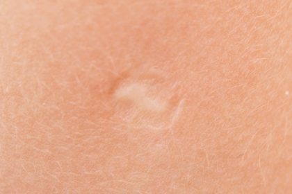 Sol Kolunuzdaki Bu İz Ne Anlama Geliyor? 12 sol kolumuzdaki asi izinin anlami