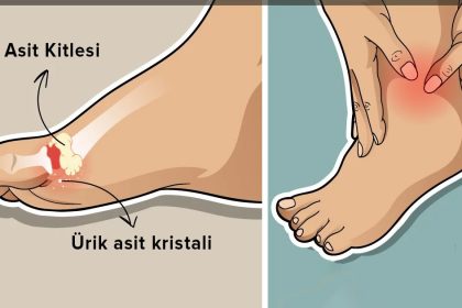 Vücuttaki Ürik Asidi Düşürebilecek 8 Besin 18 urik asit