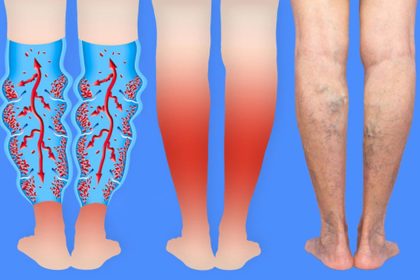 Varisli Damarlardan Kurtulmak İçin Doğal Çözümler 6 varisli damarlar icin dogal cozumler