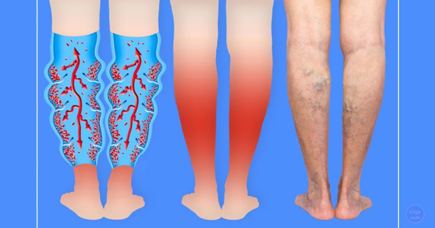 varisli damarlar icin dogal cozumler